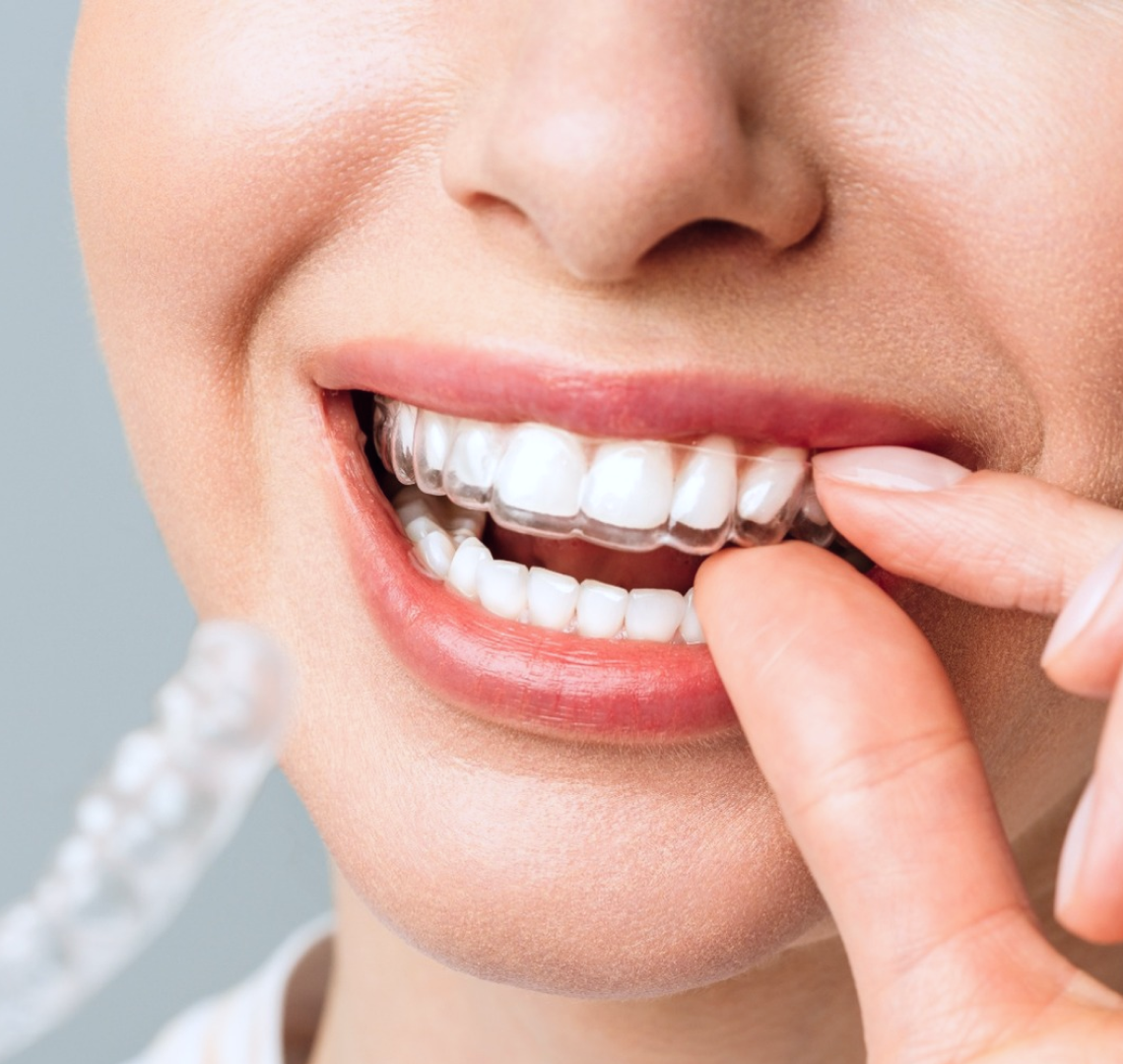 aligneurs invisibles punaauia sourire Accueil Dr Isabelle Chartres, Orthodontiste Tahiti