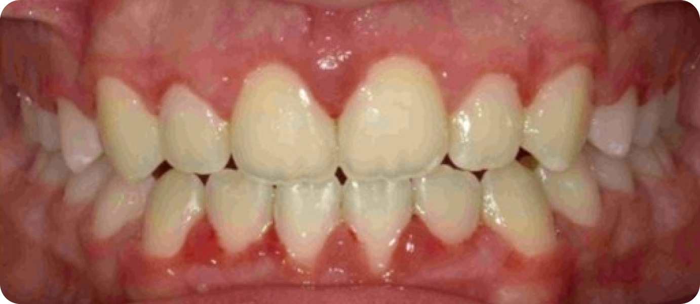 bagues ceramiques punaauia adulte, Dr Isabelle Chartres, Orthodontiste Tahiti