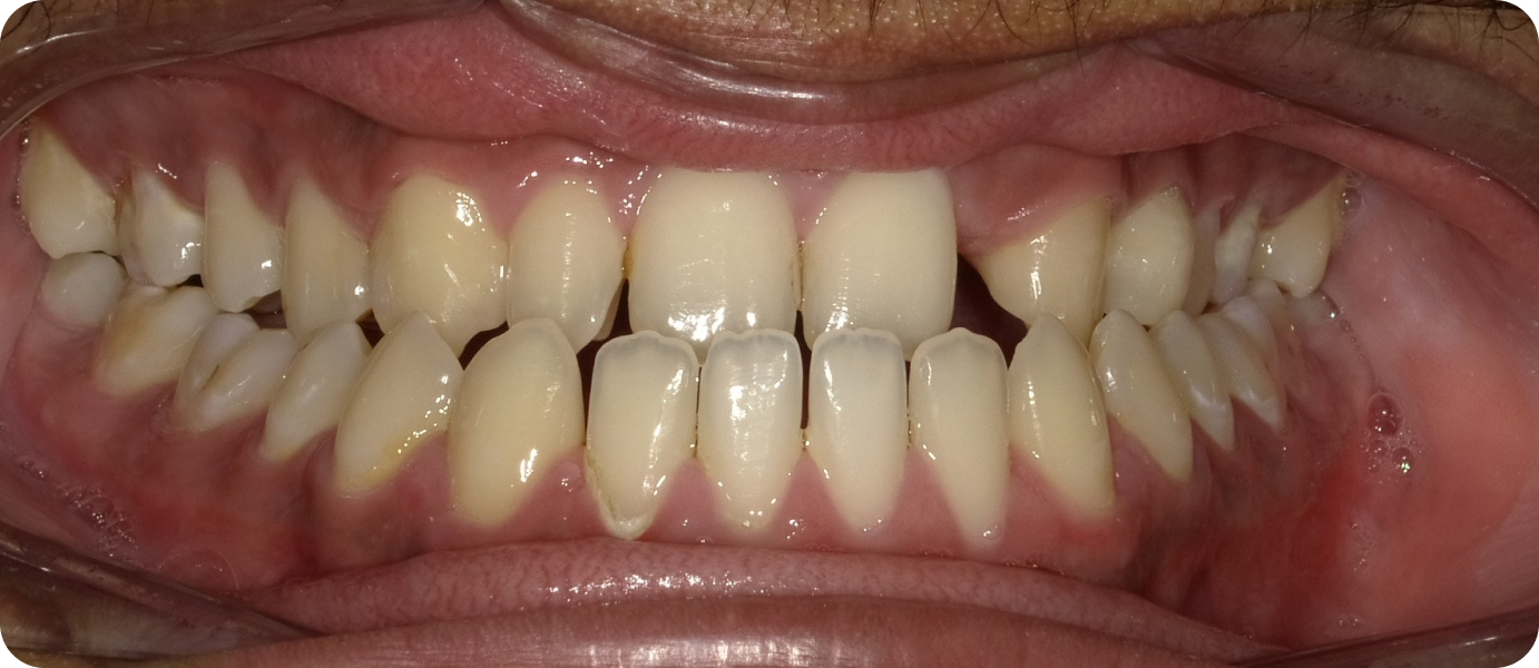 bagues ceramiques punaauia alignement, Dr Isabelle Chartres, Orthodontiste Tahiti