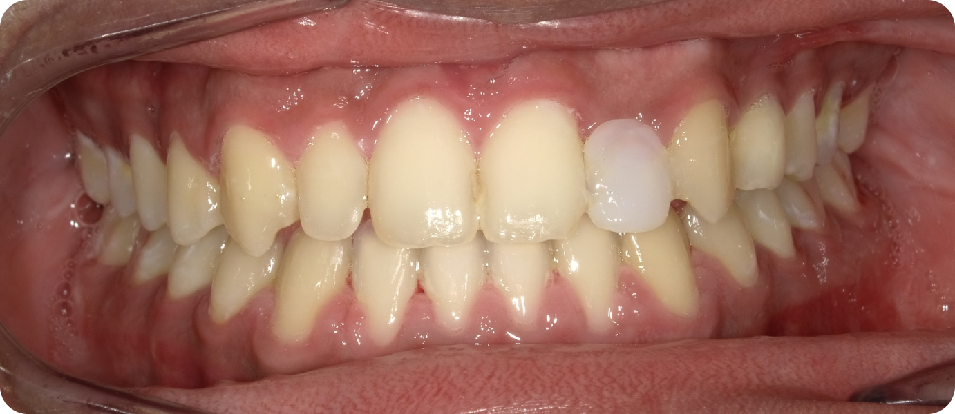 bagues ceramiques punaauia entretien, Dr Isabelle Chartres, Orthodontiste Tahiti
