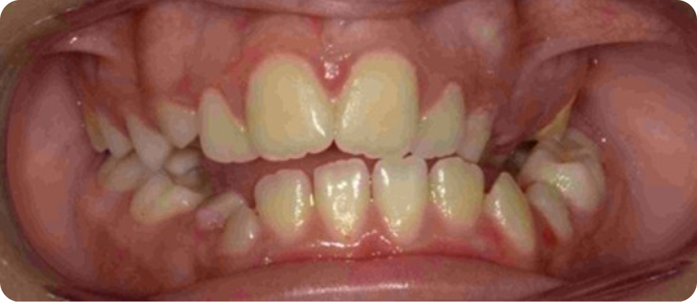 bagues ceramiques punaauia esthetiques, Dr Isabelle Chartres, Orthodontiste Tahiti