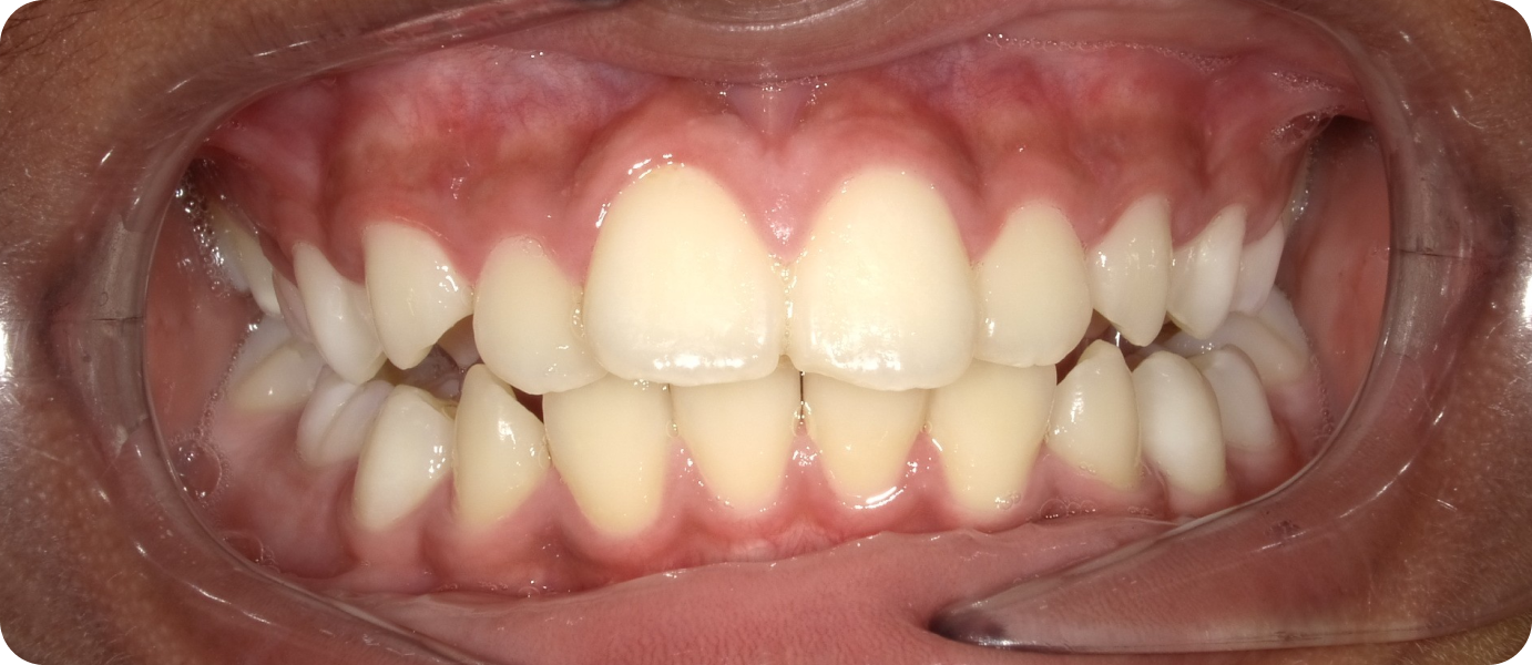 bagues ceramiques punaauia resultat, Dr Isabelle Chartres, Orthodontiste Tahiti