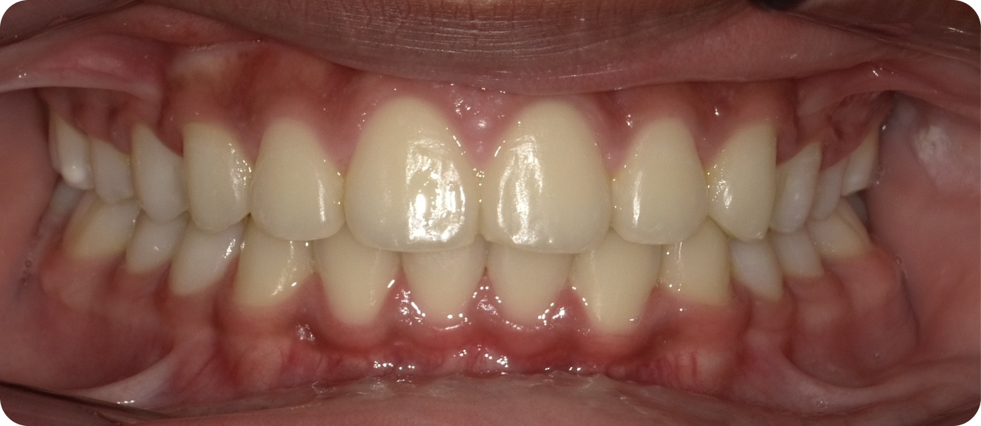 bagues ceramiques punaauia traitement, Dr Isabelle Chartres, Orthodontiste Tahiti