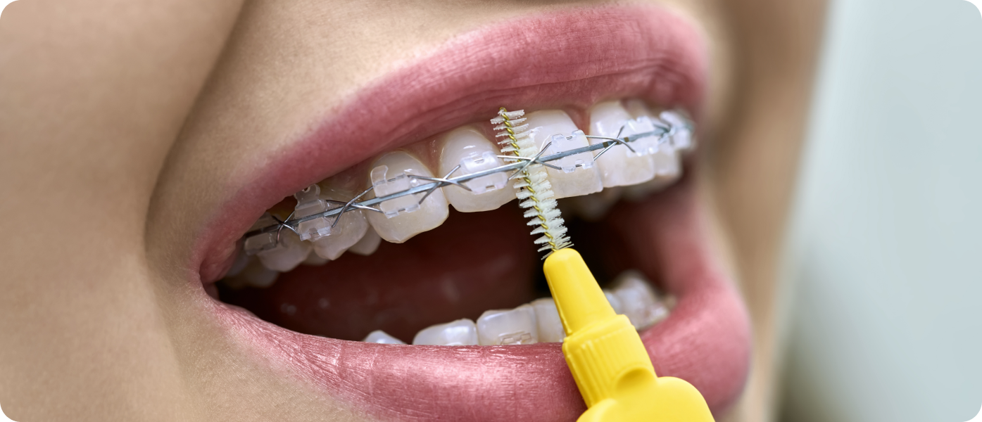 brossage apareil dentaire chartres brossage apareil dentaire chartres Hygiène bucco-dentaire Dr Isabelle Chartres, Orthodontiste Tahiti