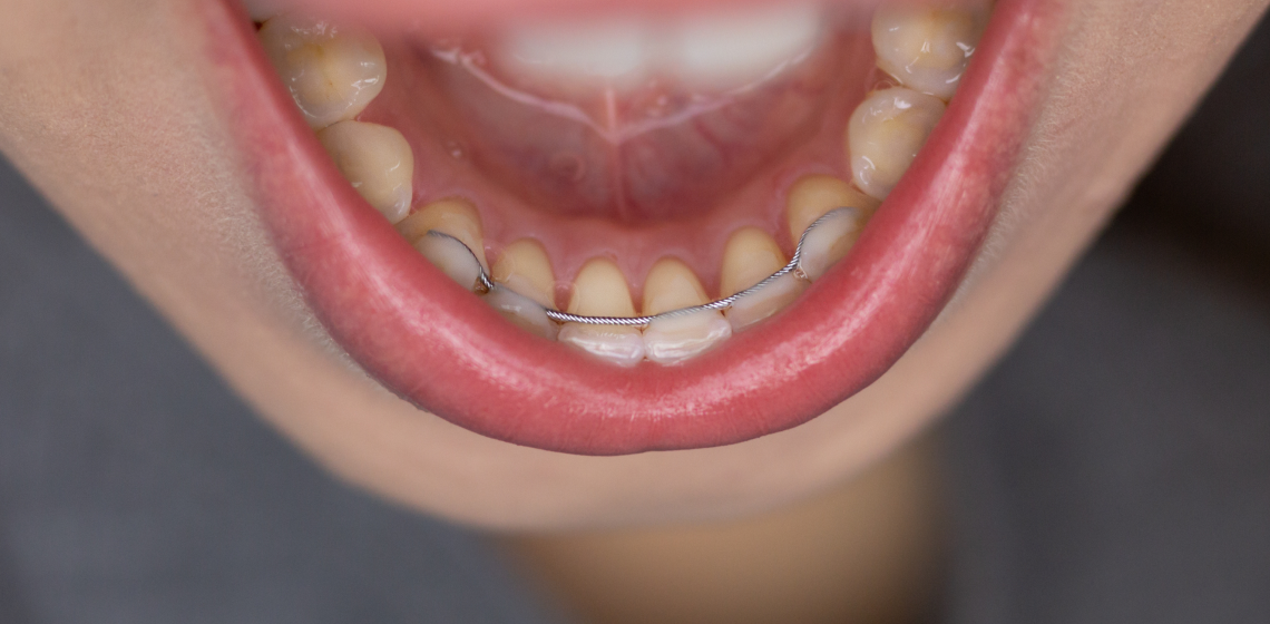dents mal alignees punaauia traitement Nos appareils Dr Isabelle Chartres, Orthodontiste Tahiti