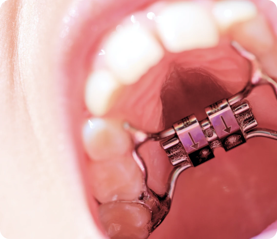 disjoncteur orthodontie appareil Disjoncteur Dr Isabelle Chartres, Orthodontiste Tahiti