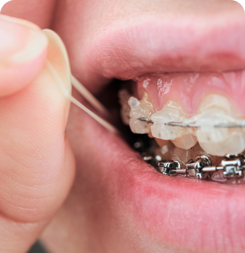elastiques dr chartres tahiti Hygiène bucco-dentaire Dr Isabelle Chartres, Orthodontiste Tahiti