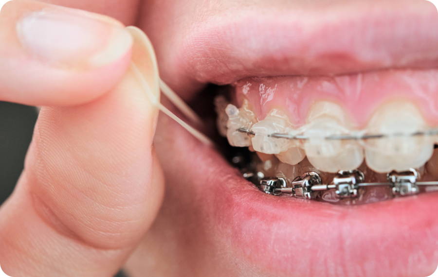 elastiques dr chartres Les élastiques : à quoi ça sert ? Dr Isabelle Chartres, Orthodontiste Tahiti
