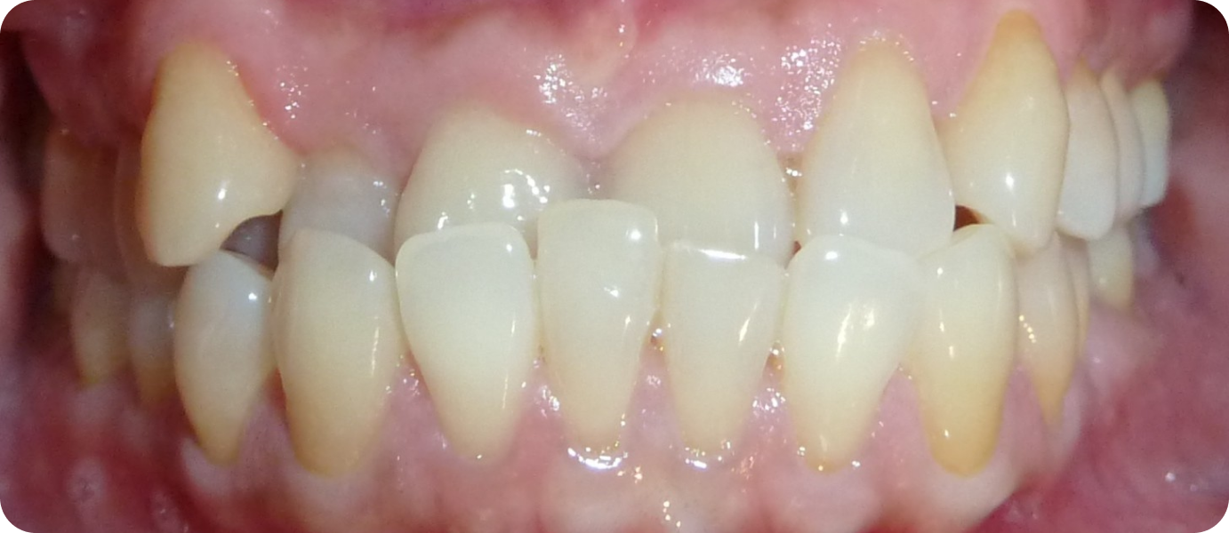 gouttieres dentaires punaauia port, Dr Isabelle Chartres, Orthodontiste Tahiti