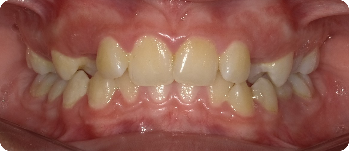 gouttieres orthodontiques punaauia discretion, Dr Isabelle Chartres, Orthodontiste Tahiti