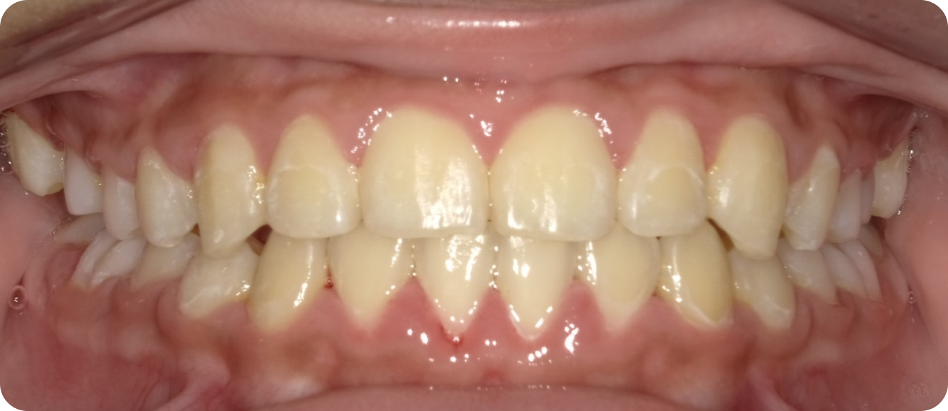 gouttieres transparentes punaauia alignement, Dr Isabelle Chartres, Orthodontiste Tahiti