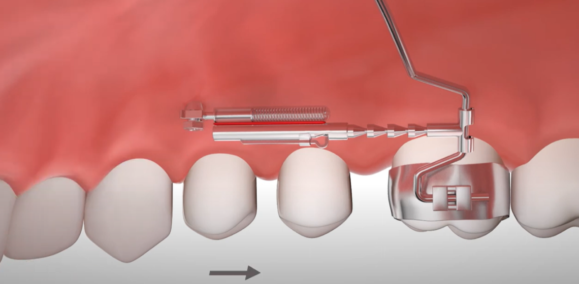 malocclusion dentaire punaauia enfant Nos appareils Dr Isabelle Chartres, Orthodontiste Tahiti
