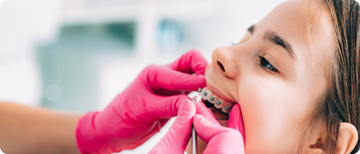 multi bagues adolescents chartres Les élastiques : à quoi ça sert ? Dr Isabelle Chartres, Orthodontiste Tahiti