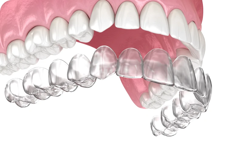 contention nocturne punaauia port Tahiti orthodontie Dr Isabelle Chartres, Orthodontiste Tahiti
