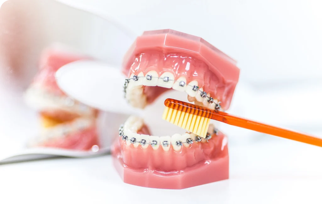 hygiene bucco dentaire punaauia appareil Appareil dentaire Dr Isabelle Chartres, Orthodontiste Tahiti