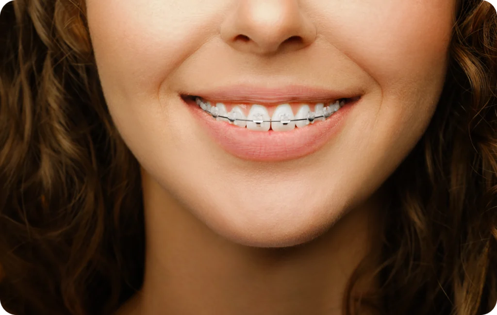 hygiene bucco dentaire punaauia bagues Appareil dentaire Dr Isabelle Chartres, Orthodontiste Tahiti
