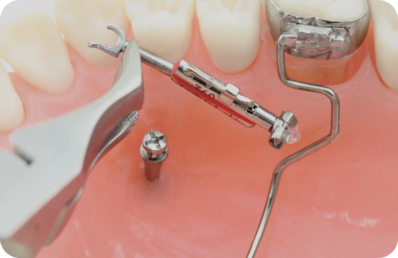topjet installation chartres orthodontie tahiti TopJet Dr Isabelle Chartres, Orthodontiste Tahiti