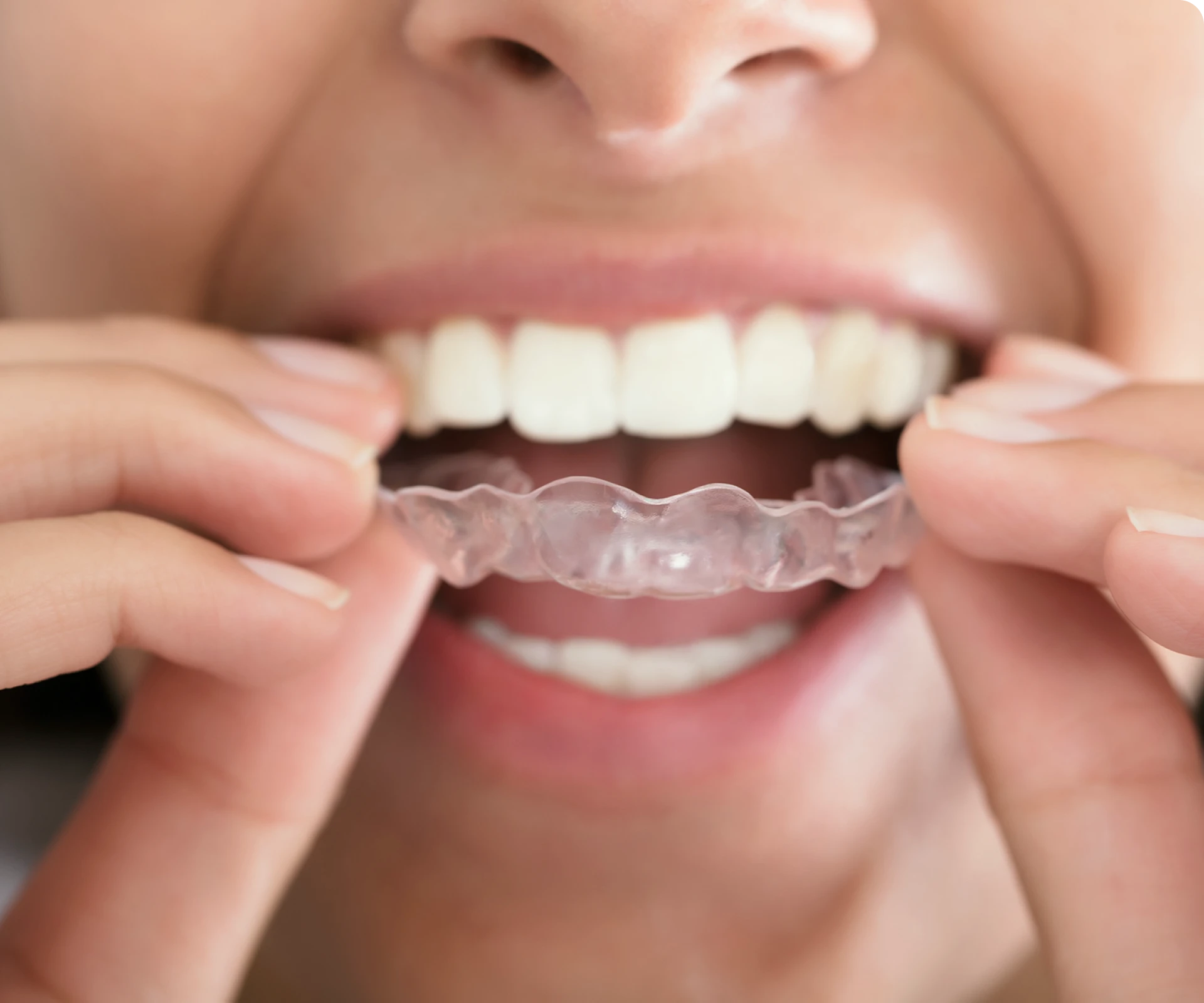 conseils orthodontiques chartres tahiti Accueil Dr Isabelle Chartres, Orthodontiste Tahiti