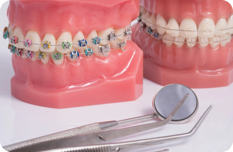 multi bagues punaauia Tahiti orthodontie Dr Isabelle Chartres, Orthodontiste Tahiti