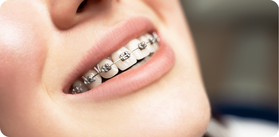 appareils dentaires punaauia enfant Nos appareils Dr Isabelle Chartres, Orthodontiste Tahiti