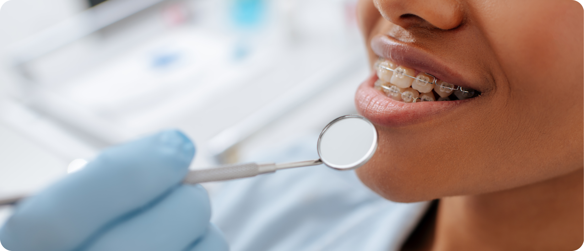 phase orthodontique Classe III (mâchoire inférieure avancée) Dr Isabelle Chartres, Orthodontiste Tahiti