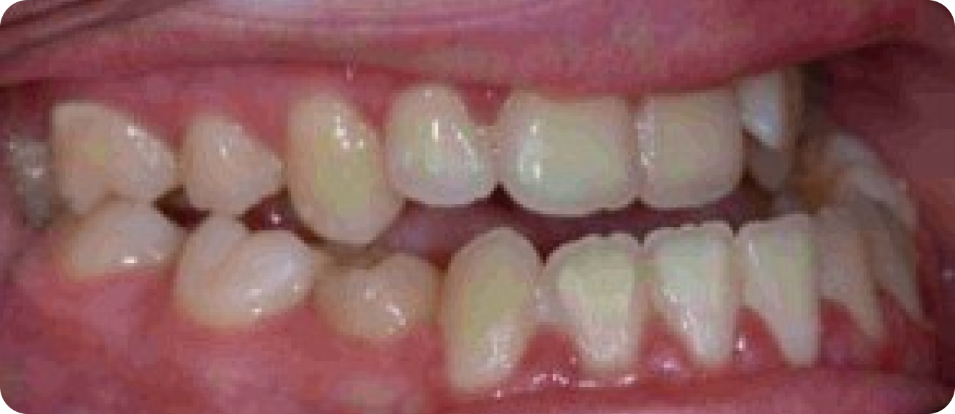 bagues ceramiques punaauia discretes, Dr Isabelle Chartres, Orthodontiste Tahiti