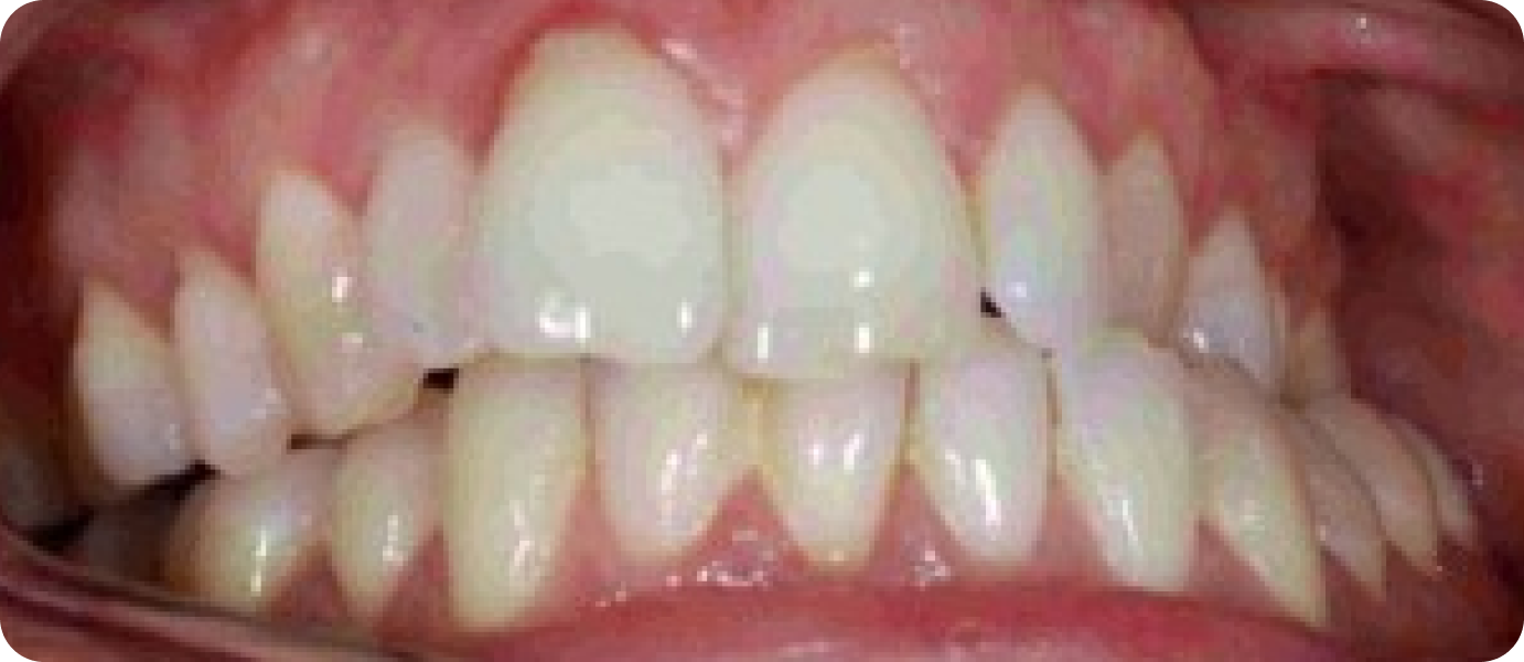 bagues metal punaauia adaptation, Dr Isabelle Chartres, Orthodontiste Tahiti