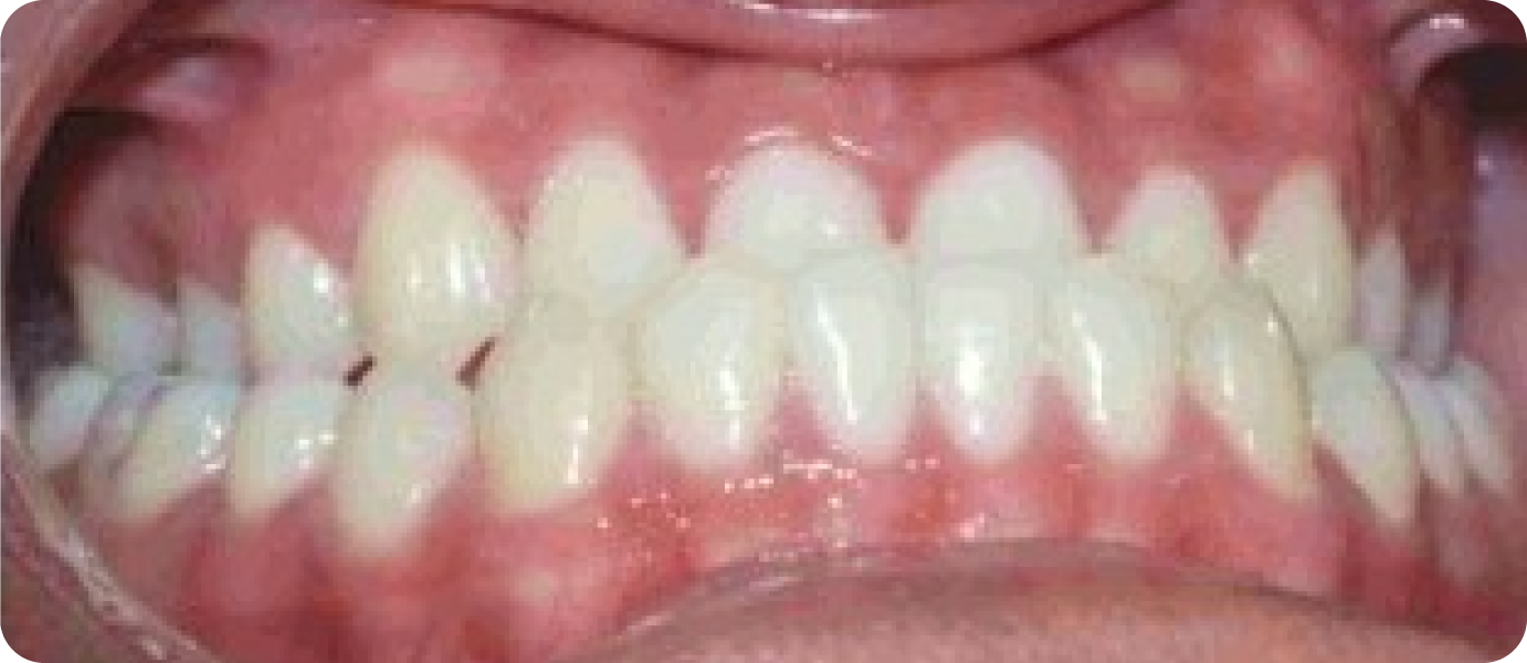 bagues metal punaauia adolescent, Dr Isabelle Chartres, Orthodontiste Tahiti