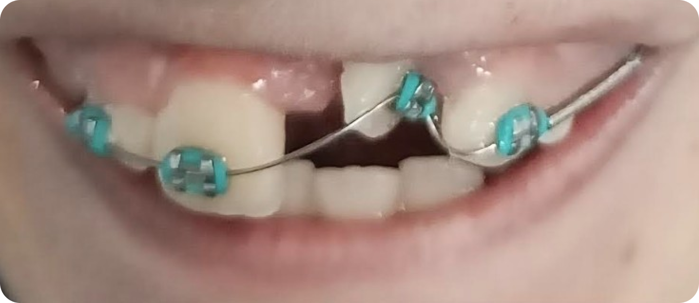 bagues metal punaauia appareil, Dr Isabelle Chartres, Orthodontiste Tahiti