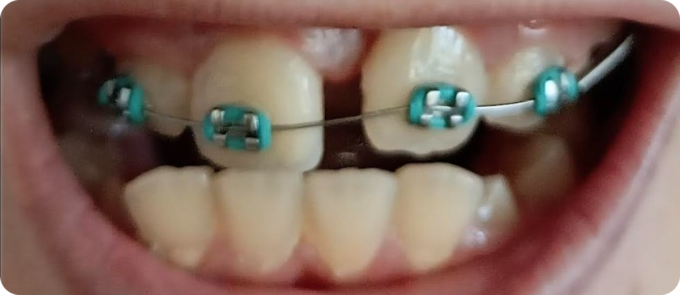 bagues metal punaauia enfant, Dr Isabelle Chartres, Orthodontiste Tahiti