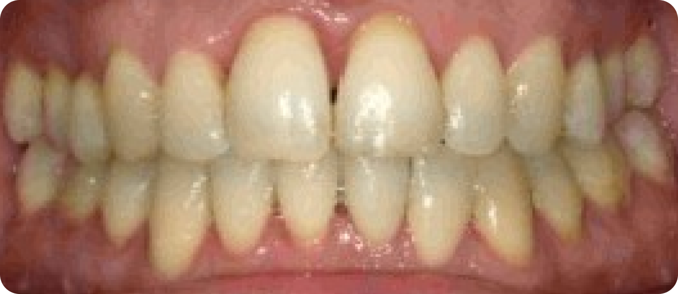 bagues metal punaauia entretien, Dr Isabelle Chartres, Orthodontiste Tahiti