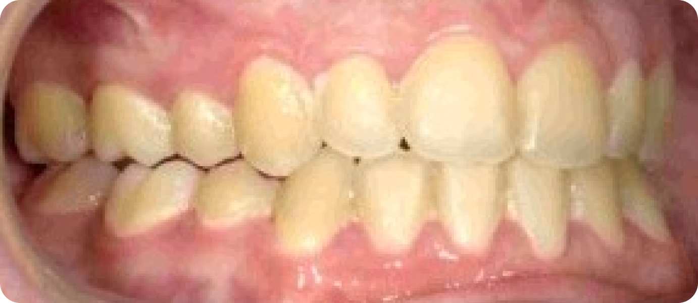 bagues metal punaauia suivi, Dr Isabelle Chartres, Orthodontiste Tahiti