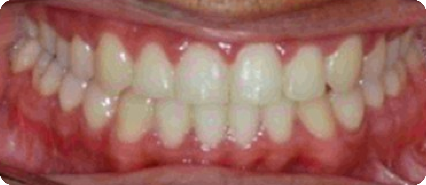 bagues metal punaauia traitement, Dr Isabelle Chartres, Orthodontiste Tahiti